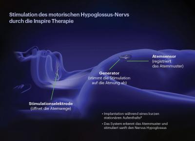 Die Zungenschrittmacher-Implantation wird in der Universitätsklinik für Hals-, Nasen- und Ohrenheilkunde, Kopf- und Halschirurgie Magdeburg seit 2021 durchgeführt. Das Implantat kann das Aussetzen der Atmung in der Nacht verhindern.